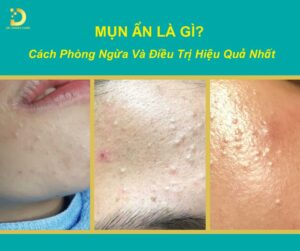 mụn ẩn là gì