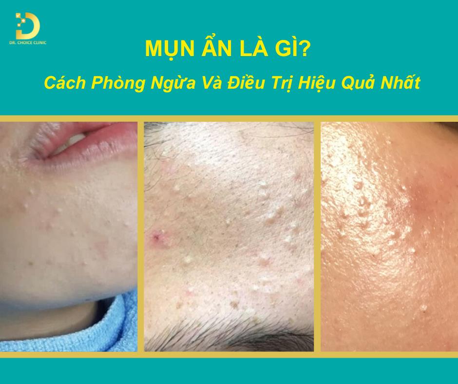 Mụn Ẩn Là Gì? Cách Phòng Ngừa Và Điều Trị Hiệu Quả Nhất 8 mụn ẩn là gì