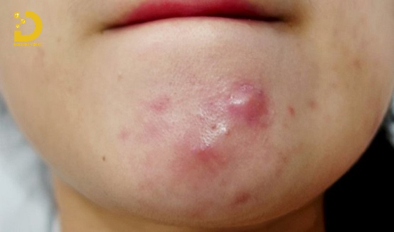 Các Loại Mụn Thường Gặp: Cách Phân Biệt & Điều Trị Phù Hợp 26 Hình ảnh mụn bọc