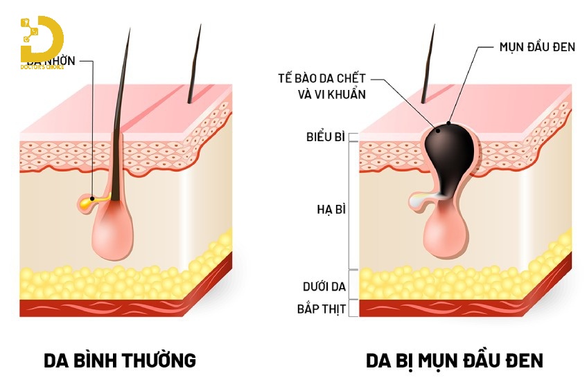 Mụn Đầu Đen Là Gì? Nguyên Nhân, Cách Chăm Sóc Và Điều Trị 12 Da bị mụn đầu đen