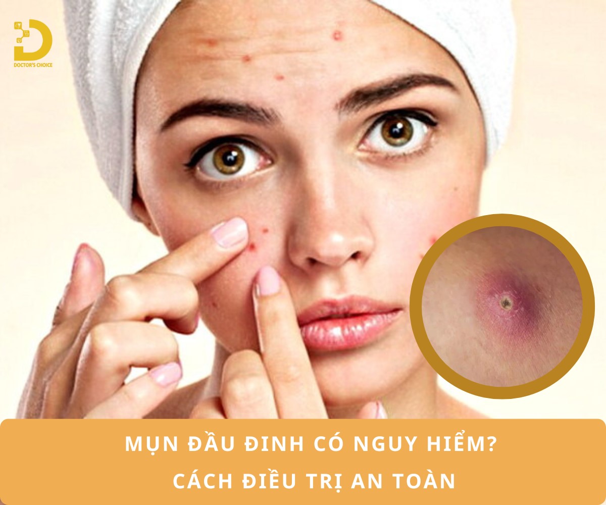 Mụn Đầu Đinh: Nguyên Nhân, Cách Nhận Biết và Điều Trị Hiệu Quả 12 Tìm hiểu về mụn đầu đinh và cách điều trị