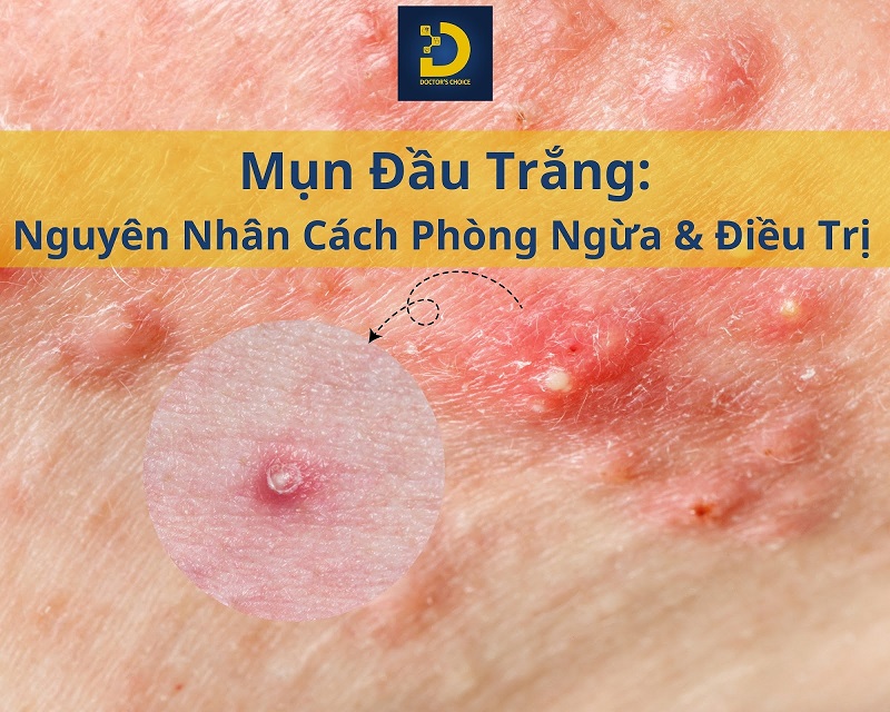 Mụn Đầu Trắng: Nguyên Nhân, Cách Phòng Ngừa Và Điều Trị 8 mun dau trang 1