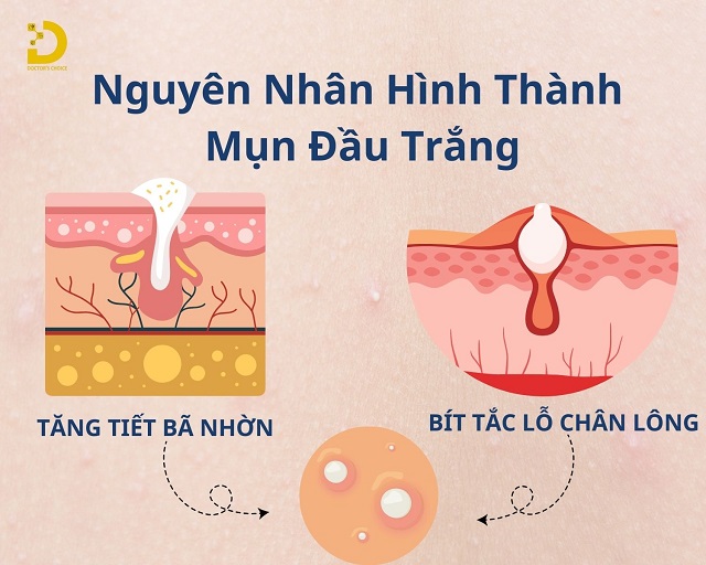 Mụn Đầu Trắng: Nguyên Nhân, Cách Phòng Ngừa Và Điều Trị 9 mun dau trang 2