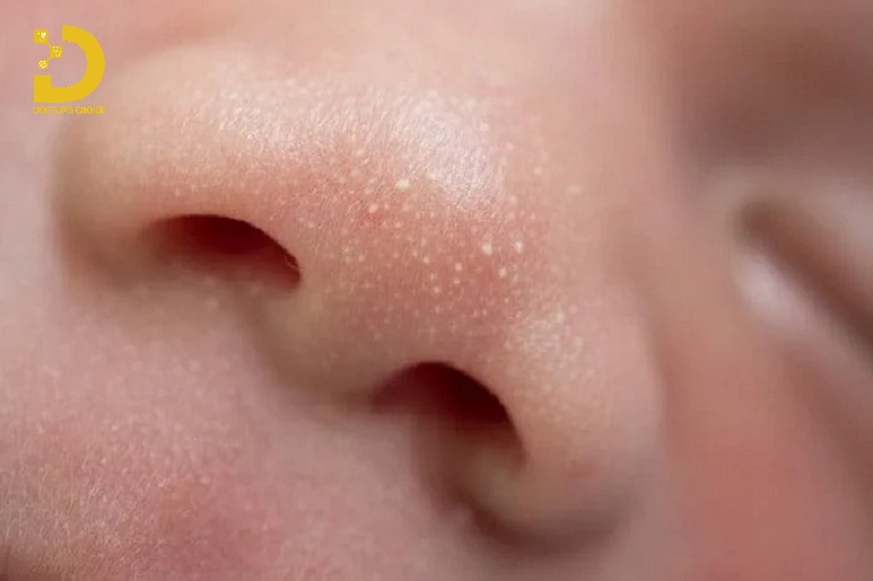 Các Loại Mụn Thường Gặp: Cách Phân Biệt & Điều Trị Phù Hợp 23 Hình ảnh mụn đầu trắng
