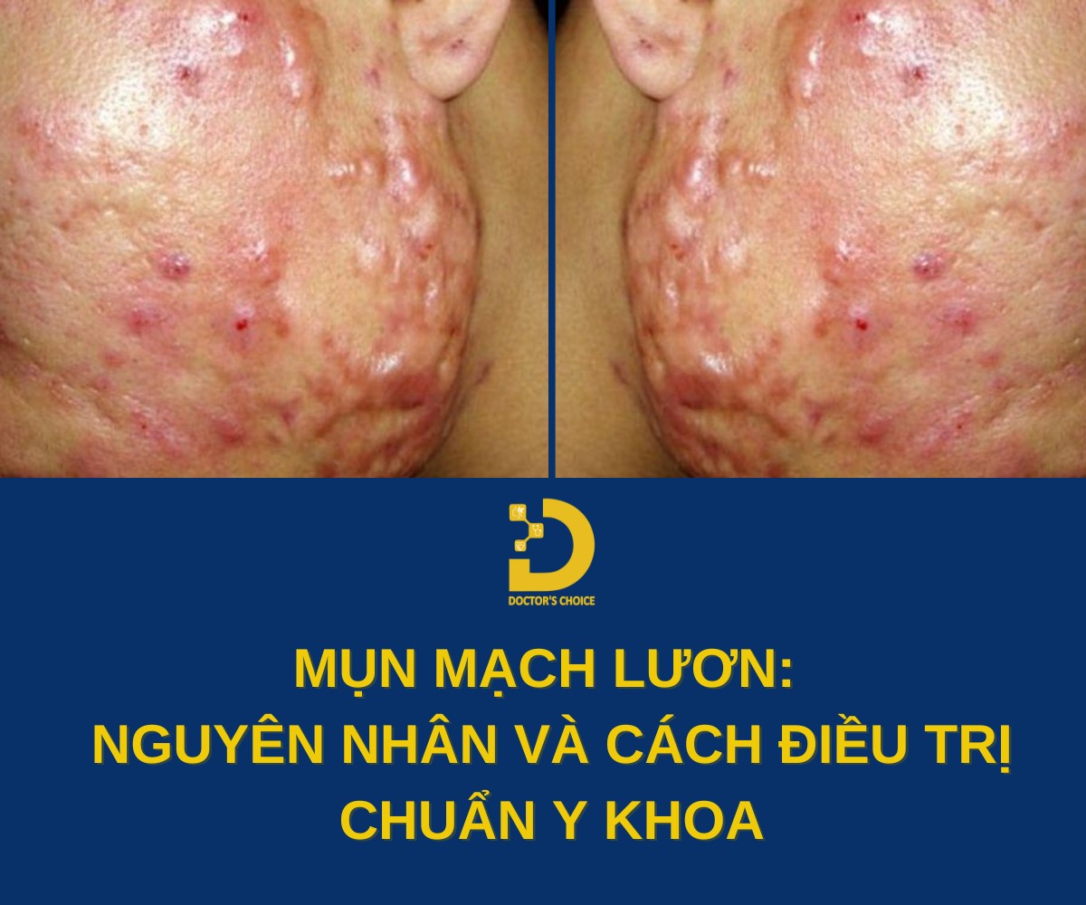 Mụn Mạch Lươn: Nguyên Nhân Và Cách Điều Trị Chuẩn Y Khoa 7 Tìm hiểu về mụn mạch lươn và cách điều trị hiệu quả, an toàn
