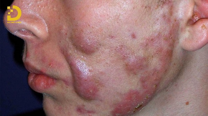 Các Loại Mụn Thường Gặp: Cách Phân Biệt & Điều Trị Phù Hợp 30 Hình ảnh mụn mạch lươn