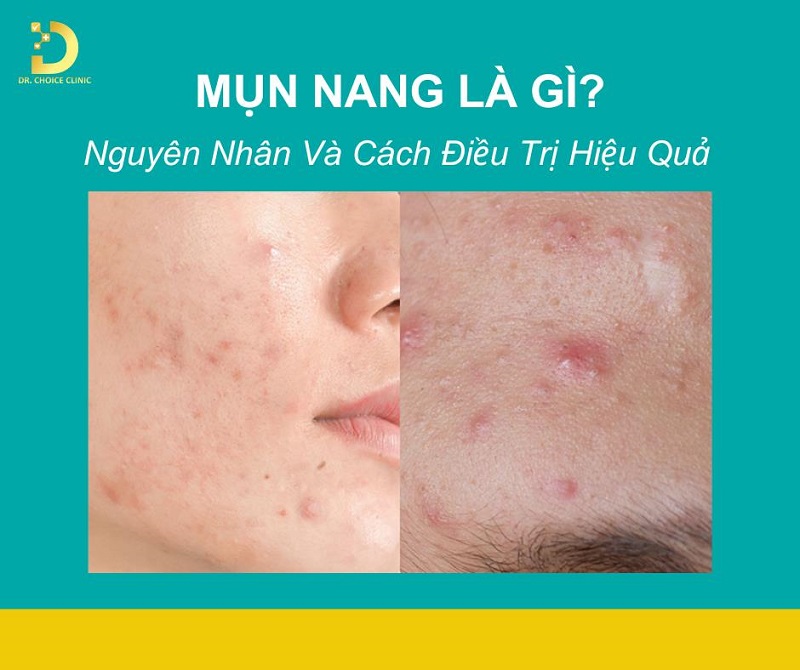 Mụn Nang Là Gì? Nguyên Nhân Và Cách Điều Trị Hiệu Quả 7 Mụn nang