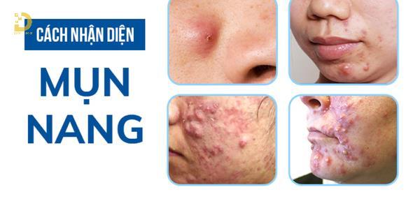 Mụn Nang Là Gì? Nguyên Nhân Và Cách Điều Trị Hiệu Quả 8 mun nang 2