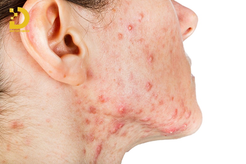 Các Loại Mụn Thường Gặp: Cách Phân Biệt & Điều Trị Phù Hợp 29 Hình ảnh mụn nang