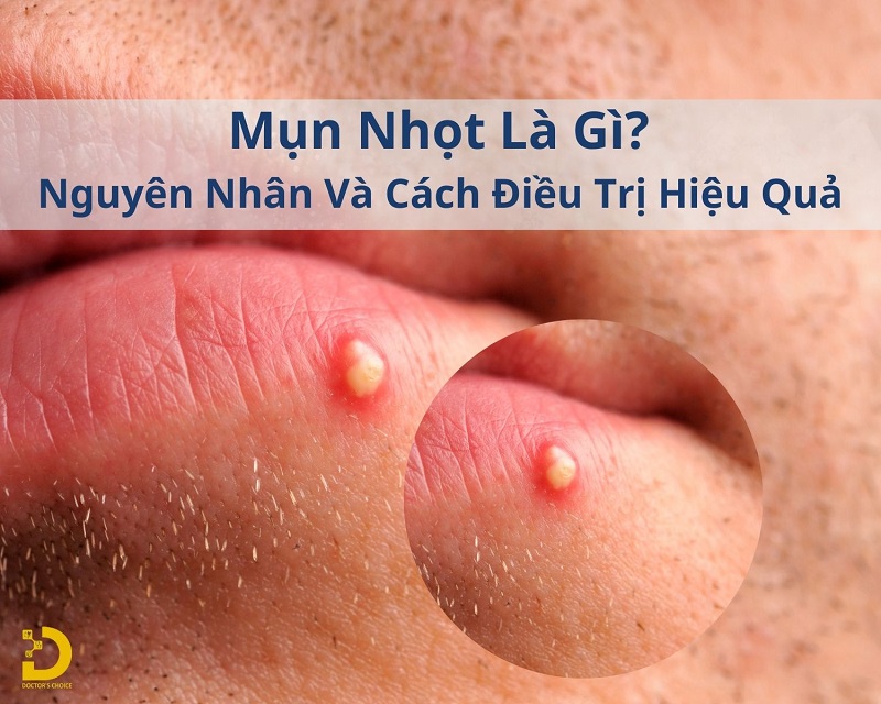 Mụn Nhọt Là Gì? Nguyên Nhân Và Cách Điều Trị Hiệu Quả 10 mụn nhọt là gì
