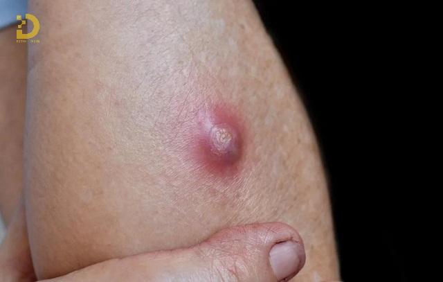 Mụn Nhọt Là Gì? Nguyên Nhân Và Cách Điều Trị Hiệu Quả 11 mun nhot 2