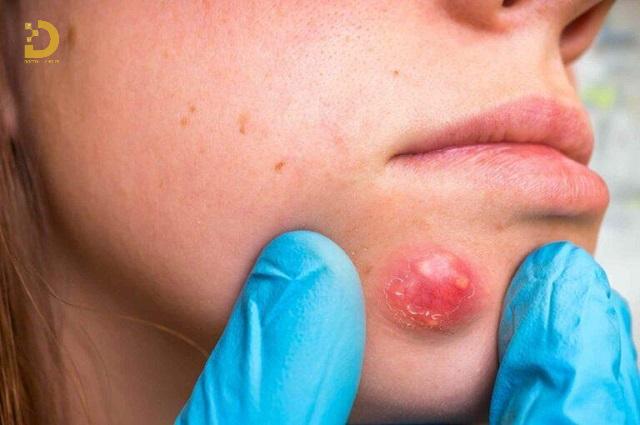 Mụn Nhọt Là Gì? Nguyên Nhân Và Cách Điều Trị Hiệu Quả 12 mun nhot 3