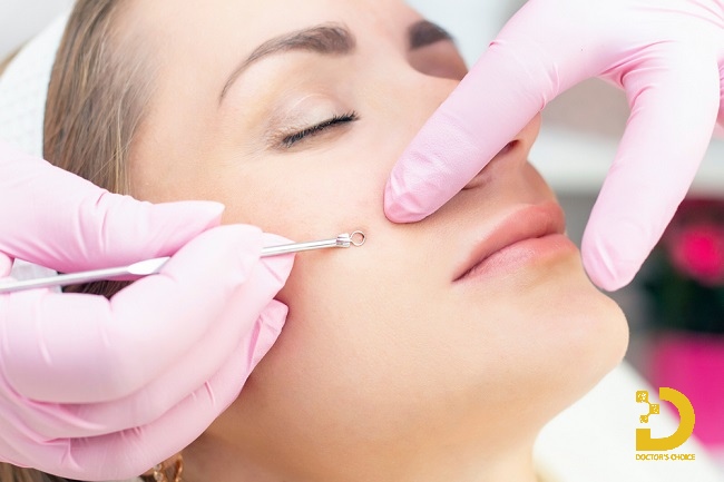 Mụn Cám: Nguyên Nhân, Cách Nặn Mụn & Điều Trị Hiệu Quả 13 Quy trình nặn mụn cám chuẩn spa