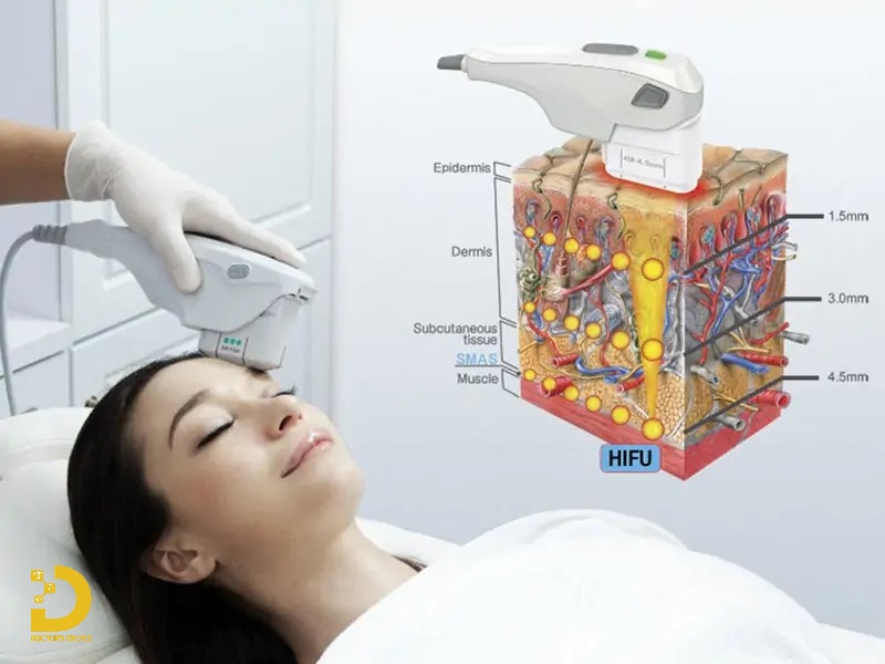Nâng Cơ Xóa Nhăn Công Nghệ Cao: Đặc Điểm, Phân Loại, Có Nên Làm? 15 Nâng cơ xóa nhăn công nghệ HIFU