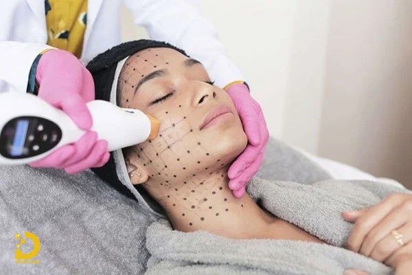 Nâng Cơ Xóa Nhăn Công Nghệ Cao: Đặc Điểm, Phân Loại, Có Nên Làm? 12 Nâng cơ trẻ hóa da công nghệ cao (ảnh minh họa)