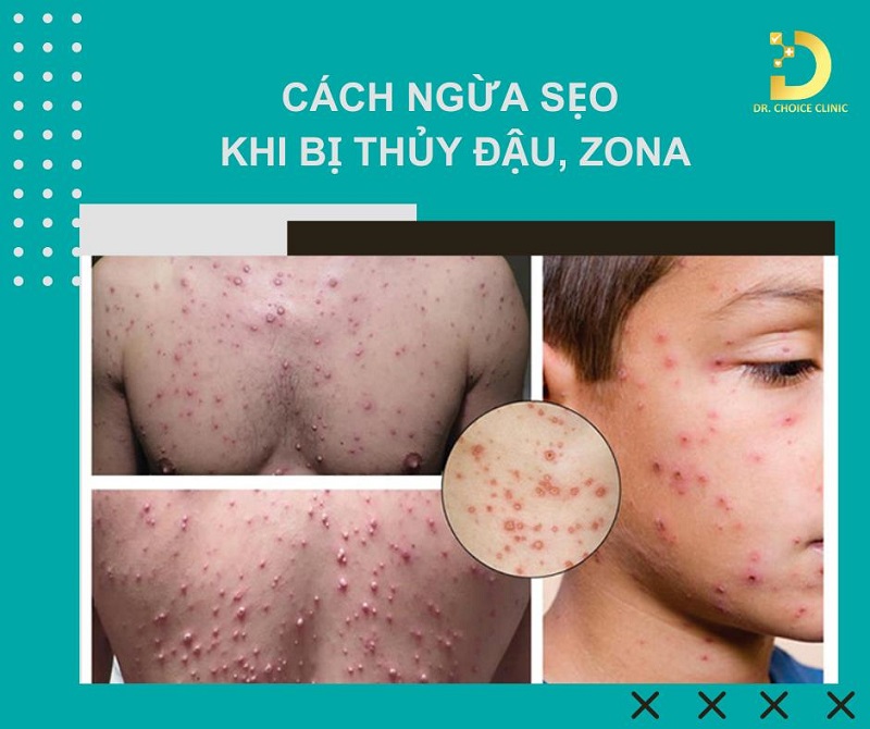 Cách Ngừa Sẹo Khi Bị Thủy Đậu, Zona Hiệu Quả 6 Cách ngừa sẹo khi bị thủy đậu/ zona