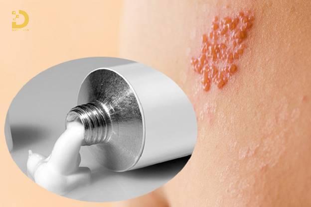 Cách Ngừa Sẹo Khi Bị Thủy Đậu, Zona Hiệu Quả 7 ngua seo thuy dau zona 2