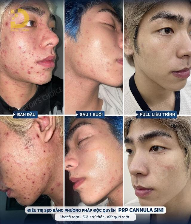 Cách Ngừa Sẹo Khi Bị Thủy Đậu, Zona Hiệu Quả 9 ngua seo thuy dau zona 3
