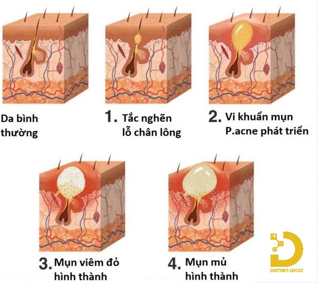 Mụn Đầu Đinh: Nguyên Nhân, Cách Nhận Biết và Điều Trị Hiệu Quả 14 Nguyên nhân gây ra mụn đầu đinh
