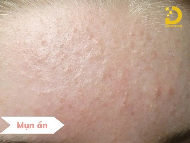 A-Z Nguyên Nhân Hình Thành Mụn & Cách Phòng Ngừa Hiệu Quả 19 Nguyên nhân hình thàn mụn ẩn