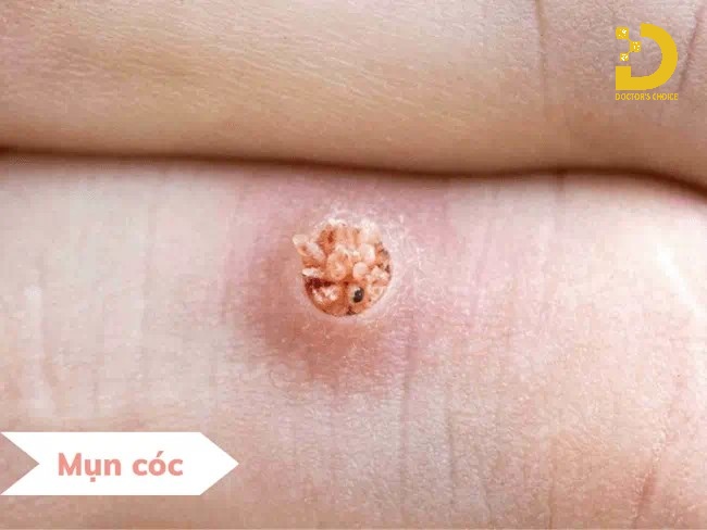 A-Z Nguyên Nhân Hình Thành Mụn & Cách Phòng Ngừa Hiệu Quả 26 Nguyên nhân gây ra mụn cóc