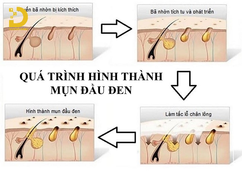 Mụn Đầu Đen Là Gì? Nguyên Nhân, Cách Chăm Sóc Và Điều Trị 13 Nguyên nhân gây ra mụn đầu đen