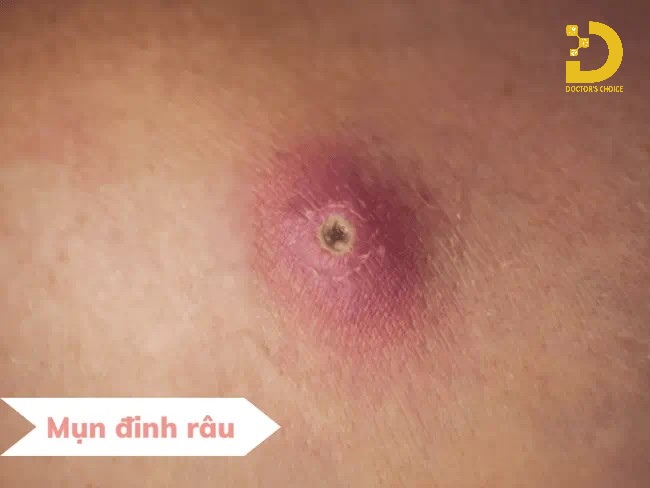 A-Z Nguyên Nhân Hình Thành Mụn & Cách Phòng Ngừa Hiệu Quả 23 Nguyên nhân gây ra mụn đinh râu (mụn đầu đinh)