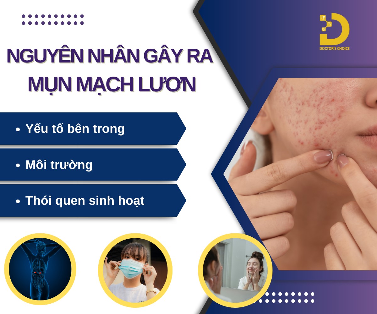 Mụn Mạch Lươn: Nguyên Nhân Và Cách Điều Trị Chuẩn Y Khoa 8 Nguyên nhân gây ra mụn mạch lươn