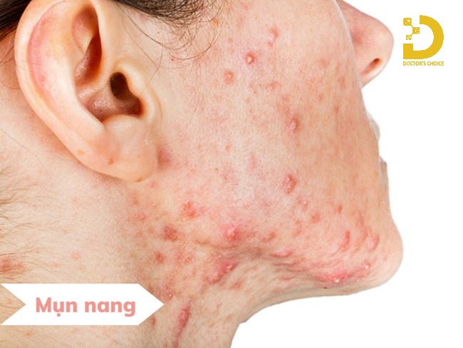 A-Z Nguyên Nhân Hình Thành Mụn & Cách Phòng Ngừa Hiệu Quả 24 Nguyên nhân gây ra mụn nang