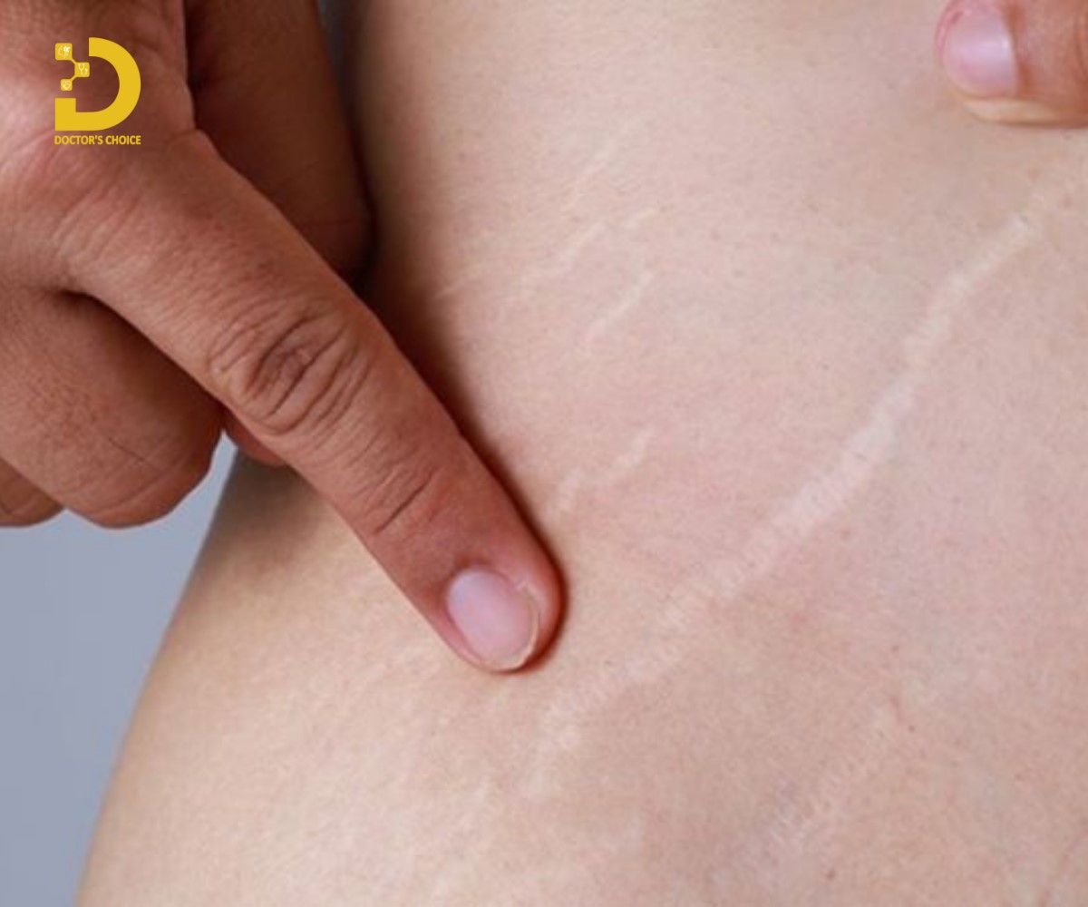 Sẹo Giãn Là Gì? Cách Phòng Ngừa Và Điều Trị Hiệu Quả 11 Seoh giãn do tăng cân nhanh, có thai, tuổi tác, di truyền, bệnh lý, dùng thuốc.