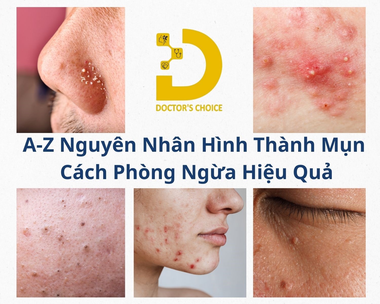 A-Z Nguyên Nhân Hình Thành Mụn & Cách Phòng Ngừa Hiệu Quả 16 Nguyên nhân hình thành các loại mụn