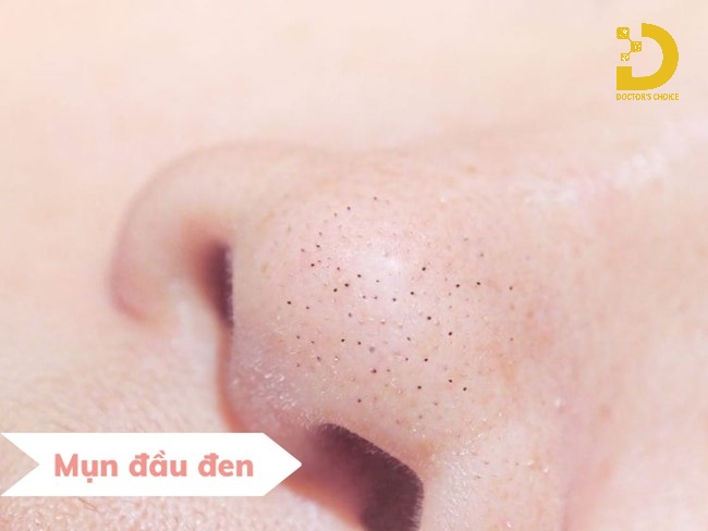 A-Z Nguyên Nhân Hình Thành Mụn & Cách Phòng Ngừa Hiệu Quả 17 Nguyên nhân hình thành mụn đầu đen