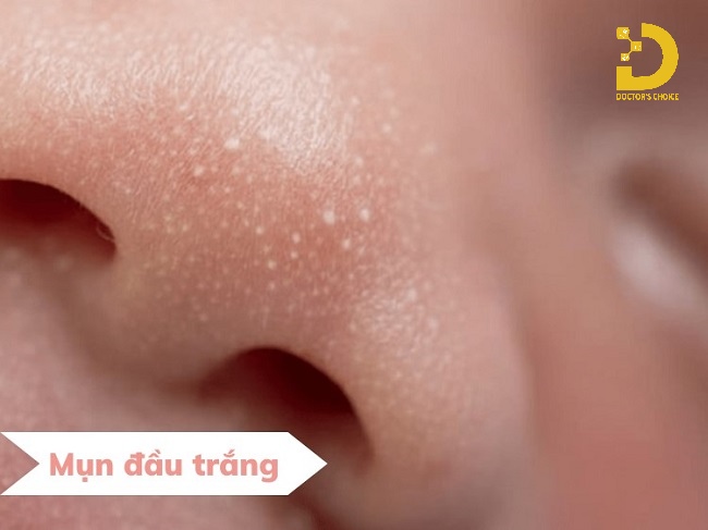 A-Z Nguyên Nhân Hình Thành Mụn & Cách Phòng Ngừa Hiệu Quả 18 Nguyên nhân hình thành mụn đầu trắng