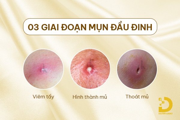 Mụn Đầu Đinh: Nguyên Nhân, Cách Nhận Biết và Điều Trị Hiệu Quả 15 Các giai đoạn hình thành mụn đầu đinh
