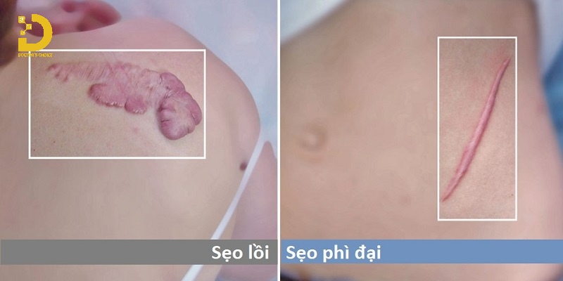 Sẹo Phì Đại Là Gì? Dấu Hiệu Nhận Biết Và Cách Điều Trị 12 Phân biệt sẹo phì đại và sẹo lồi