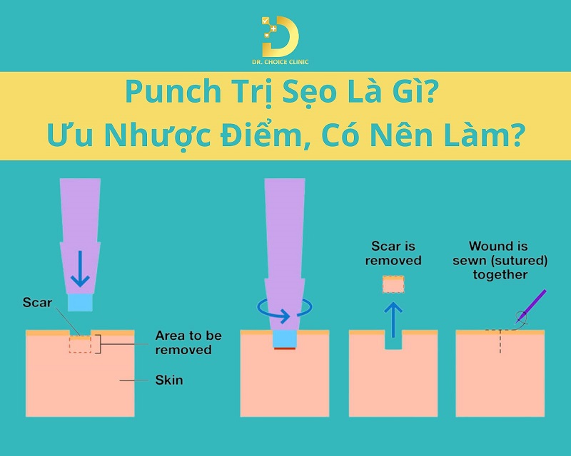 Punch Trị Sẹo Là Gì? Ưu Nhược Điểm, Có Nên Làm? 10 Punch trị seo là gì