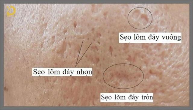 Punch Trị Sẹo Là Gì? Ưu Nhược Điểm, Có Nên Làm? 13 punch tri seo 4