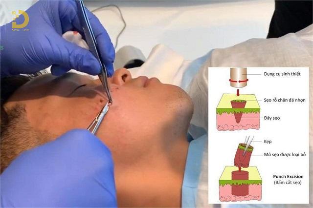 Punch Trị Sẹo Là Gì? Ưu Nhược Điểm, Có Nên Làm? 14 punch tri seo 5