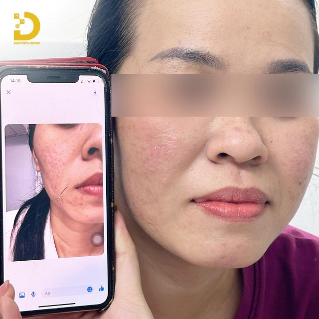 Punch Trị Sẹo Là Gì? Ưu Nhược Điểm, Có Nên Làm? 17 punch tri seo 8