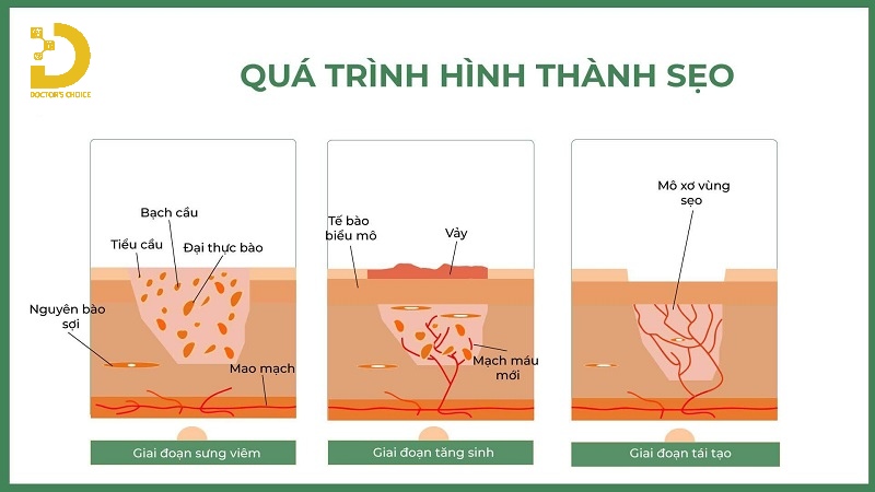 Sẹo Phì Đại Là Gì? Dấu Hiệu Nhận Biết Và Cách Điều Trị 11 Quá trình hình thành sẹo phì đại