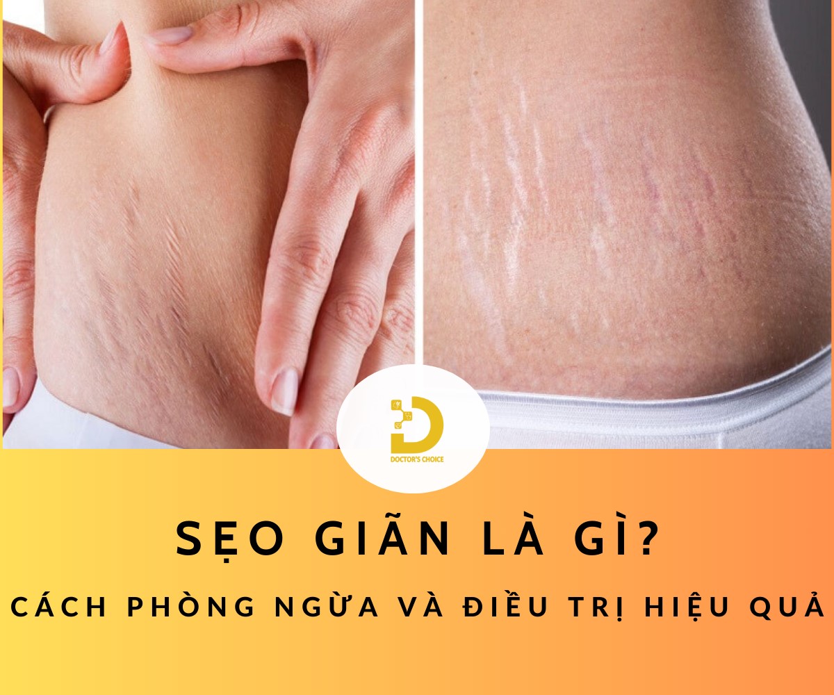 Sẹo Giãn Là Gì? Cách Phòng Ngừa Và Điều Trị Hiệu Quả 10 Tìm hiểu về sẹo giãn và cách điều trị