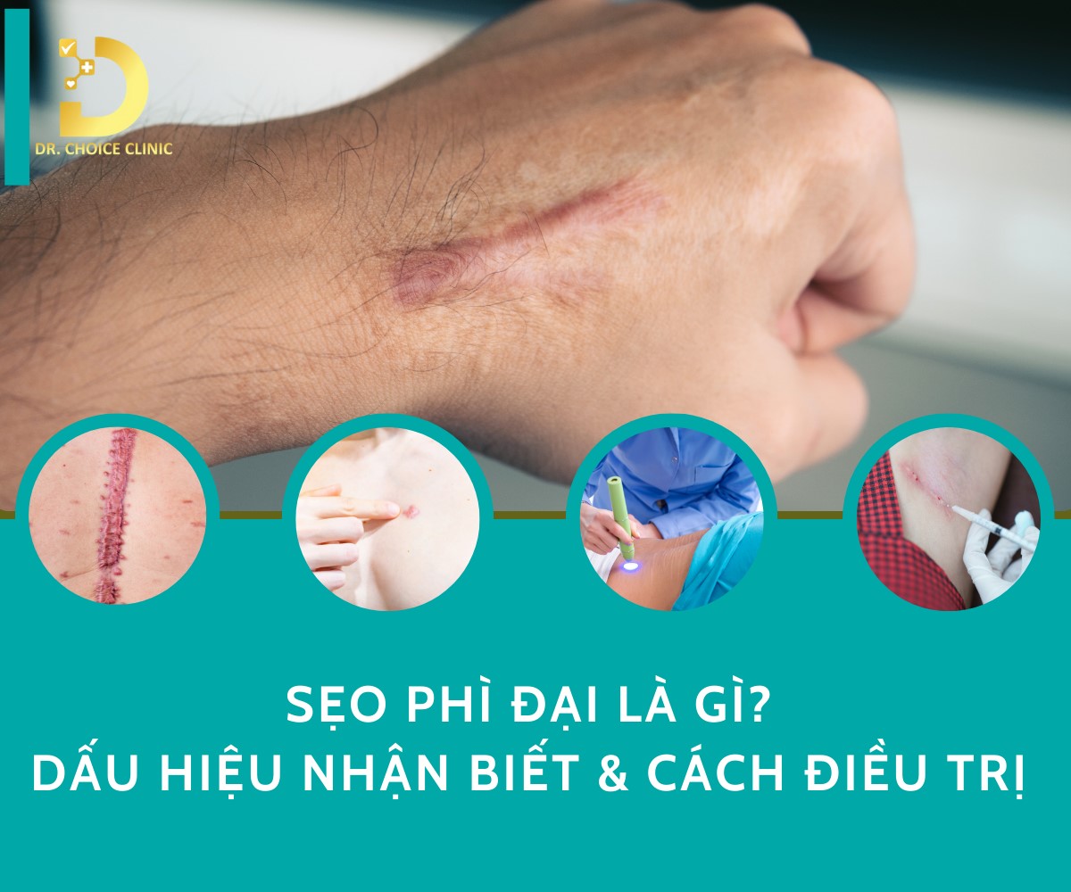 Sẹo Phì Đại Là Gì? Dấu Hiệu Nhận Biết Và Cách Điều Trị 10 Tìm hiểu về sẹo phì đại và cách điều trị