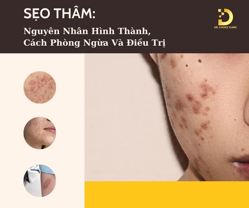 Sẹo Thâm: Nguyên Nhân Hình Thành, Cách Phòng Ngừa Và Điều Trị 7 Sẹo thâm là gì