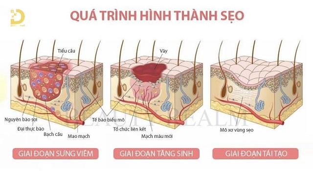 Sẹo Thâm: Nguyên Nhân Hình Thành, Cách Phòng Ngừa Và Điều Trị 8 seo tham la gi 2