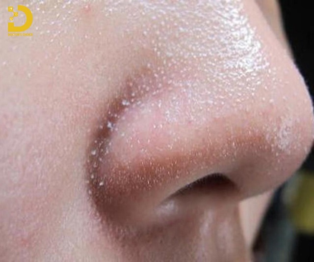Sợi Bã Nhờn: Nguyên Nhân Và Cách Loại Bỏ Hiệu Quả 8 soi ba nhon 2