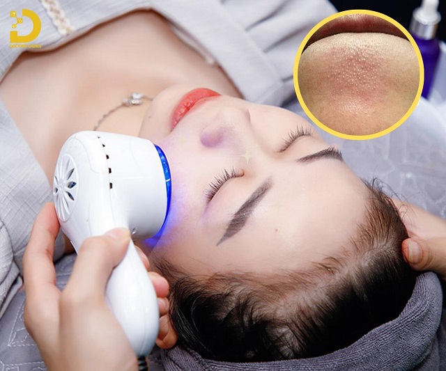 Sợi Bã Nhờn: Nguyên Nhân Và Cách Loại Bỏ Hiệu Quả 10 soi ba nhon 3