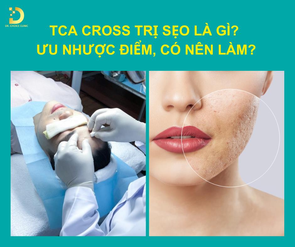 TCA Cross Trị Sẹo Là Gì? Ưu Nhược Điểm, Có Nên Làm? 9 TCA Cross trị sẹo