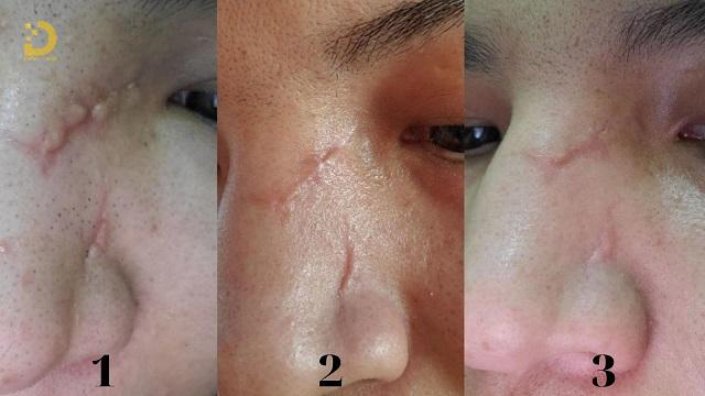 TCA Cross Trị Sẹo Là Gì? Ưu Nhược Điểm, Có Nên Làm? 12 tca cross tri seo 5