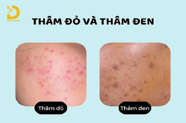 Thâm Da Do Đâu? Các Loại Thâm Da Thường Gặp Và Cách Điều Trị Hiệu Quả 13 Các tình trạng thâm da