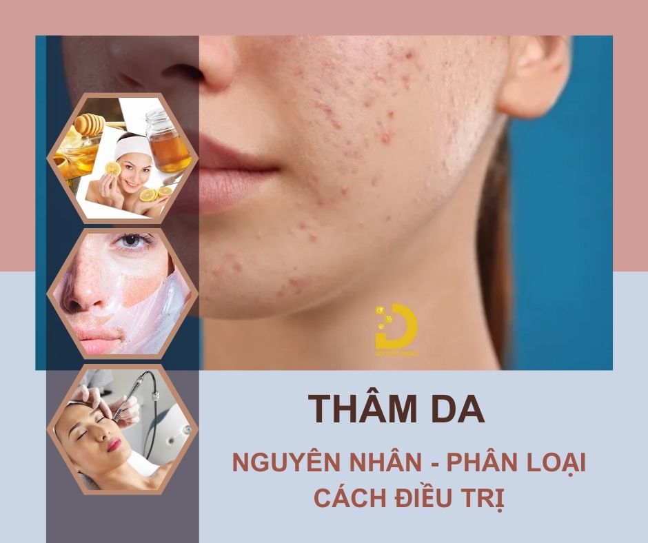 Thâm Da Do Đâu? Các Loại Thâm Da Thường Gặp Và Cách Điều Trị Hiệu Quả 10 Tình trạng thâm da và cách điều trị